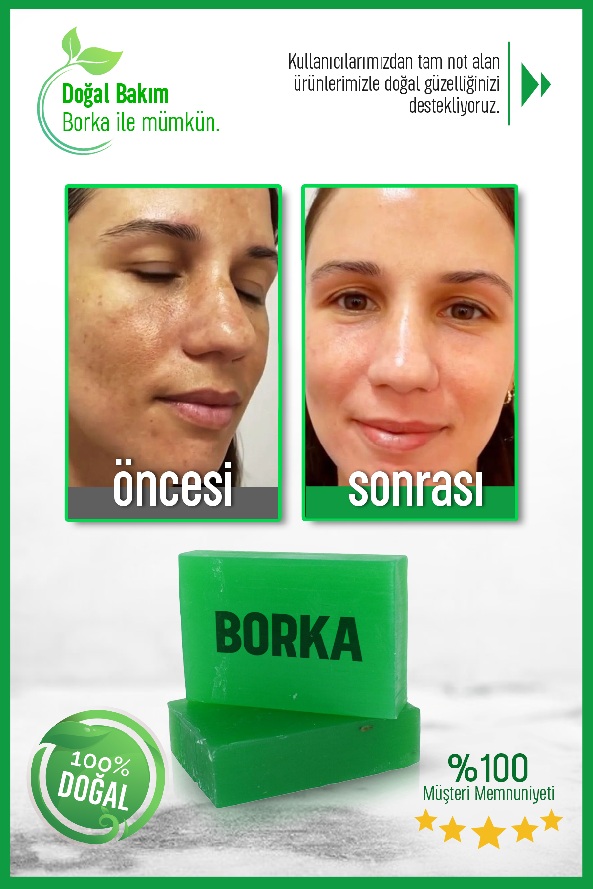 Doğal Azelaik Asit Sabun